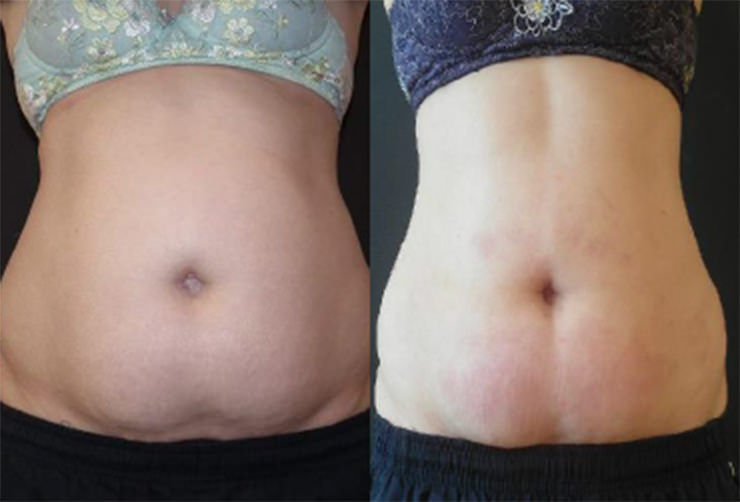 VelaShape + UltraShape Combined - Results may vary from person to person.